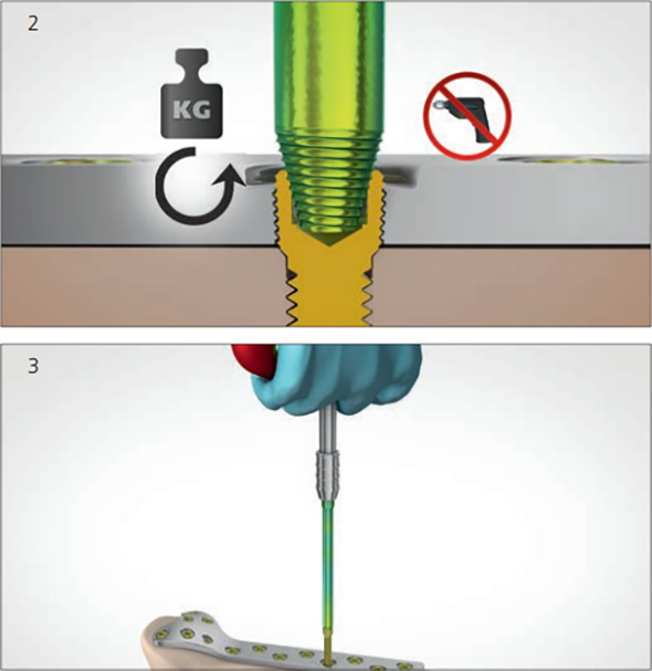 PB Swiss Surgical Screw Extraction Tools